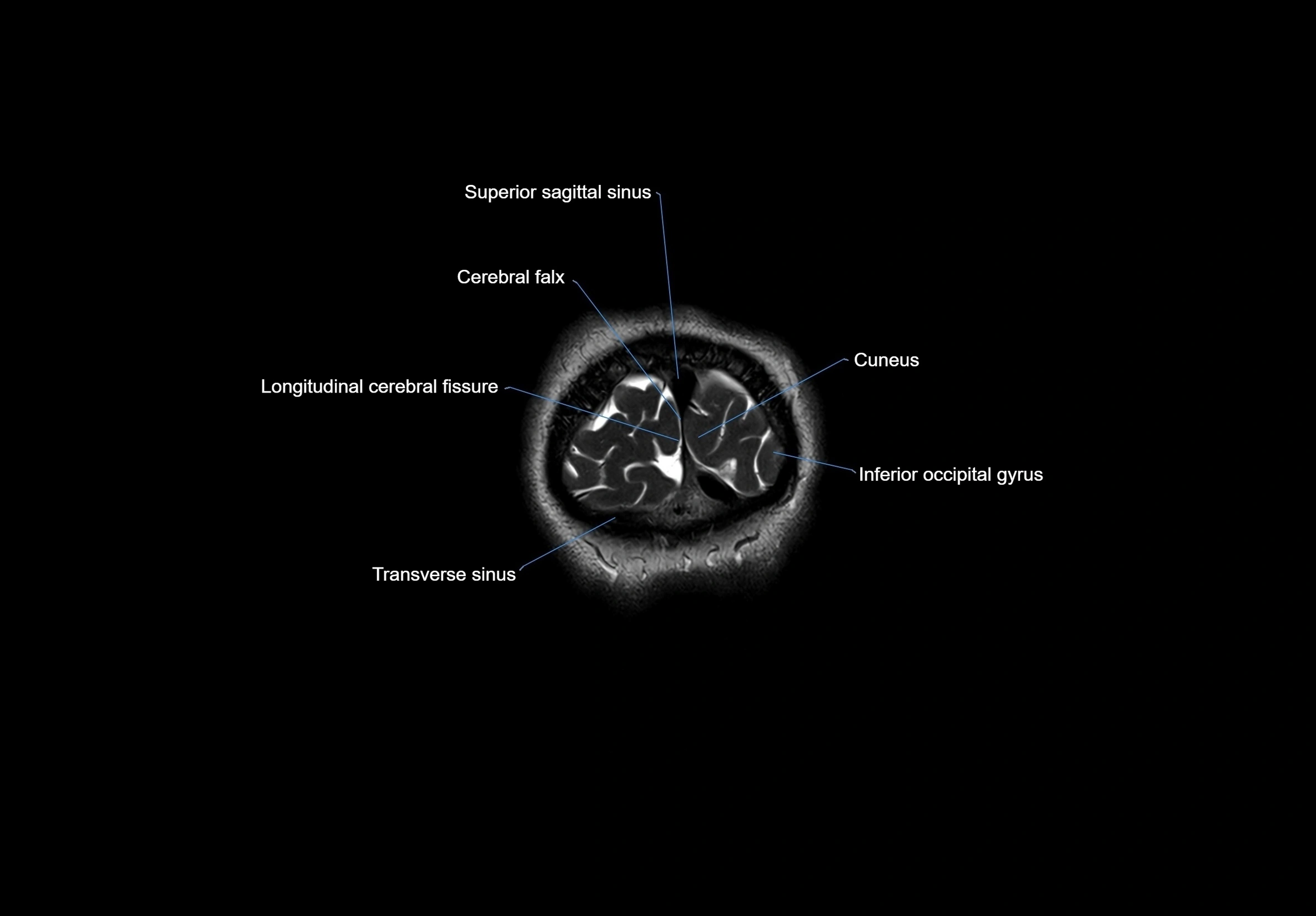 MRI Brain coronal cross sectional labelled anatomy 3T image  -img-00001-00072.webp
